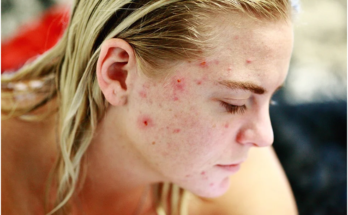 5 Proven Tips For Reducing Acne