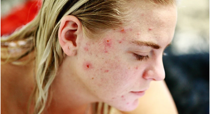 5 Proven Tips For Reducing Acne