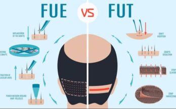 FUE and FUT Hair Transplant